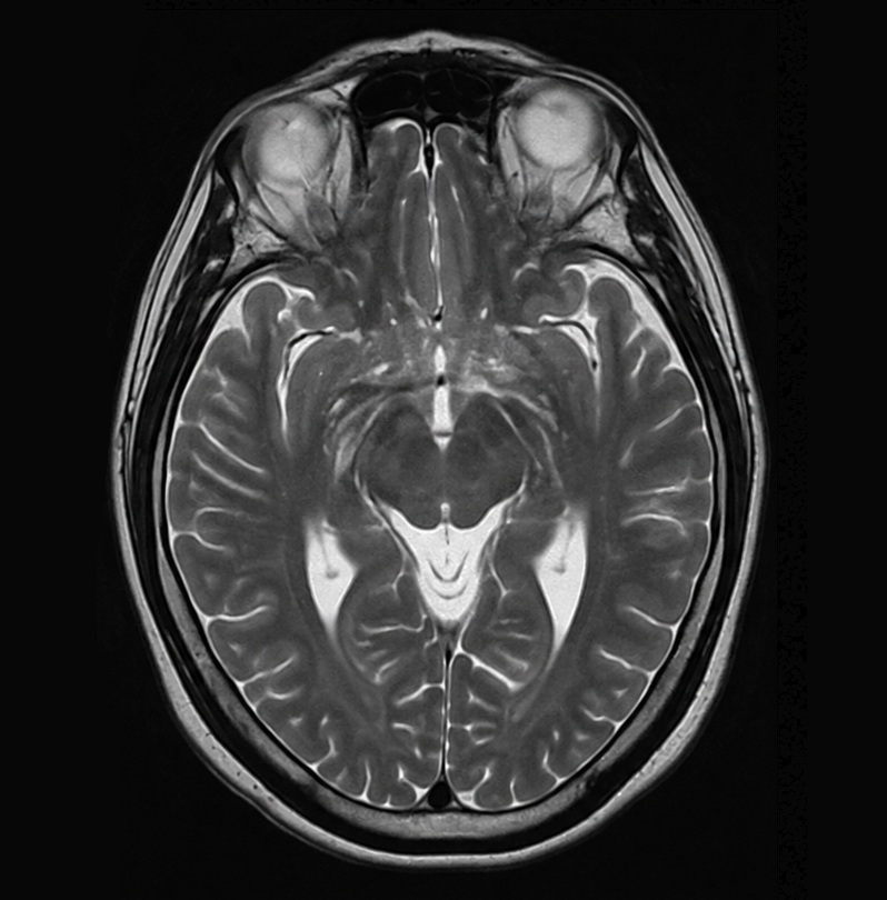 MRI